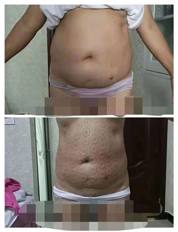 腹部塑形案例