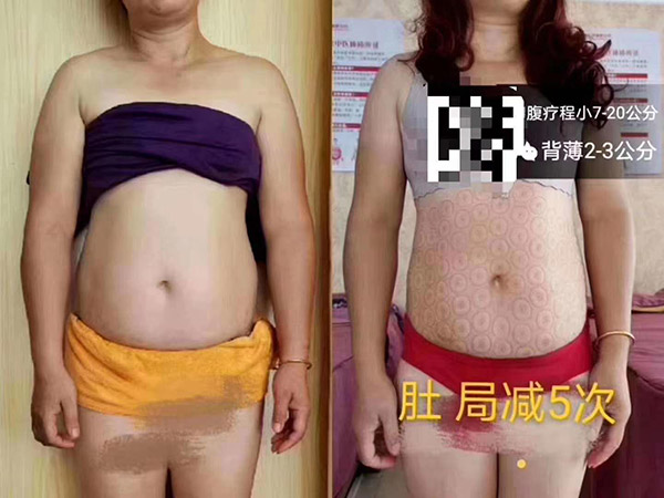 腹部局减5次效果