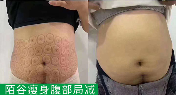 腹部局减效果对比